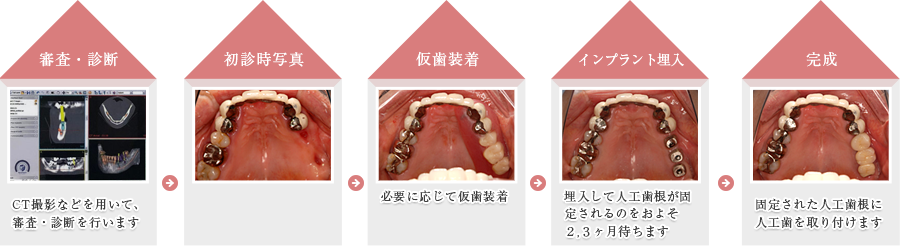 インプラントの流れ