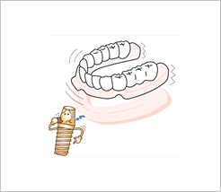 インプラント
