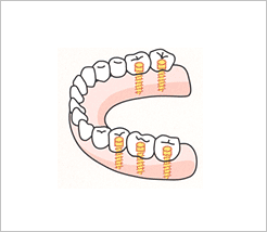インプラントのメリット