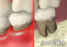 歯周病